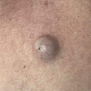 cirurgia de cisto em manaus