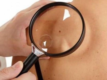 MELANOMA, PREVENIRLO E RICONOSCERLO PRECOCEMENTE
