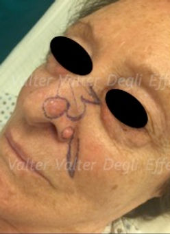 doppio carcinoma basocellulare del naso