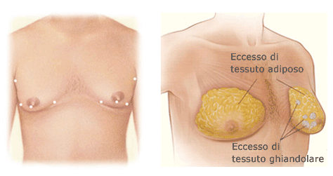 Ginecomastia falsa e vera eccesso adipo ed ipertrofia ghiandolare