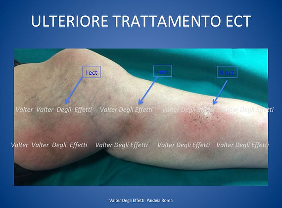 trattamento di metastasi da melanoma