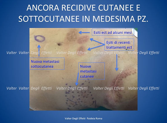 ancora trattamento di metastasi di k mammella