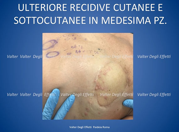 trattamento di metastasi da k mammella