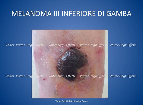 trattamento delle metastasi da melanoma