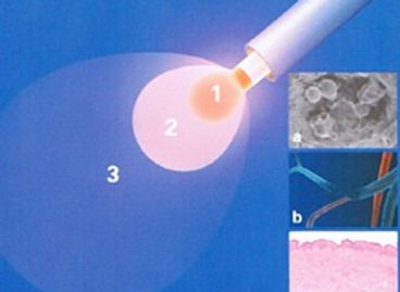 il raggio laser e le zone di azione