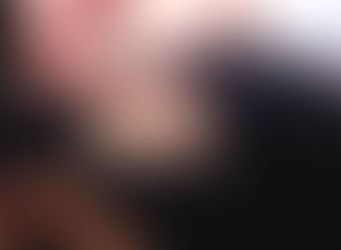 LA PILLOLA CHE FARA' RICRESCERE I CAPELLI NELL'ALOPECIA AREATA