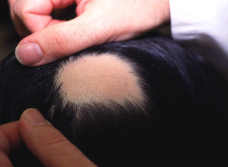 LA PILLOLA CHE FARA' RICRESCERE I CAPELLI NELL'ALOPECIA AREATA