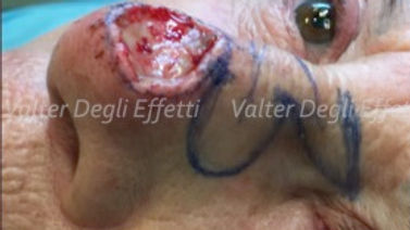 melanoma punta naso