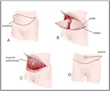 diastasi muscoli retti. pancia piatta