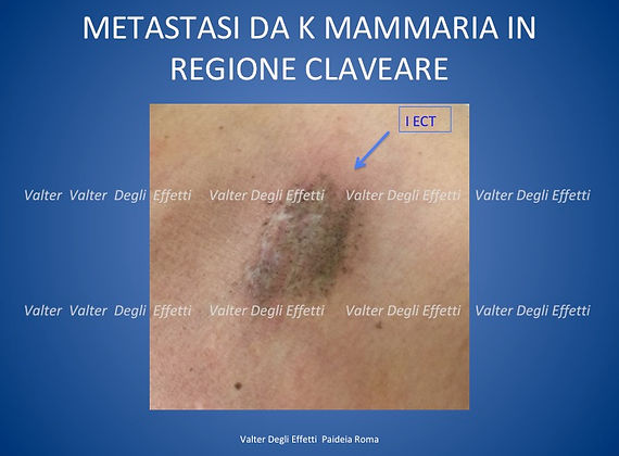 trattamento di metastasi di k mammella