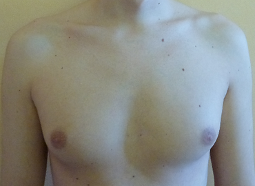 pre-operatorio