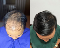 Foto Before After HT 4