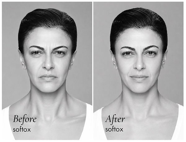 Before en after Annette Softox