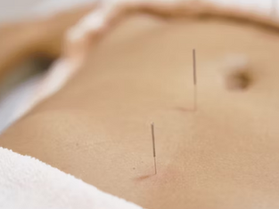 What is Endometriosis, and How Does Acupuncture Help?