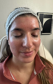 Before Microneedling with CO2 Lift Mask