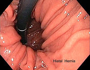 HIATUS%20HERNIA_edited.jpg