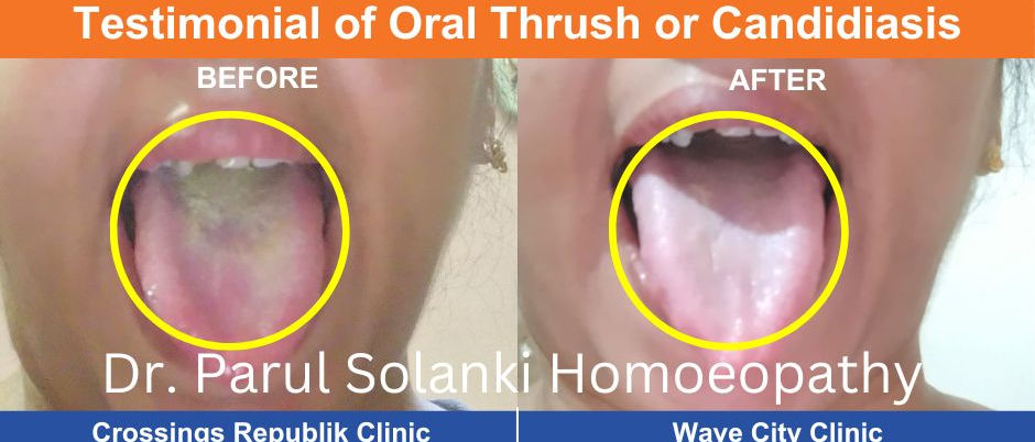 Oral thrush (candidiasis)—white patches on the tongue treated with homeopathy