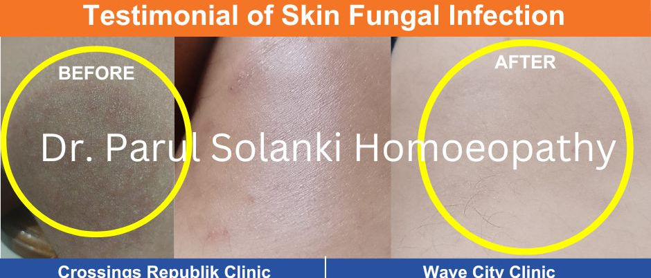 Close-up of a circular, red, scaly skin rash on a leg, typical of a fungal infection like ringworm