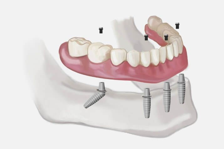 Placas con implantes