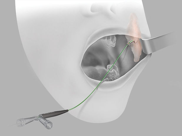content-img-full-advance-salivary-duct.jpg