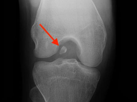 When Something’s “Floating” in Your Joint: Understanding Loose Bodies in the Knee, Ankle, and Shoulder