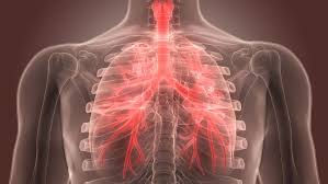 Bromquitis