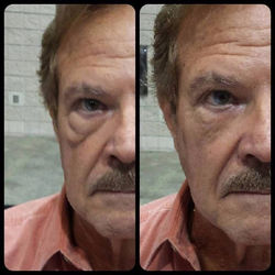 Instantly-Ageless-for-bags-and-Dark-Circle-Eye-Treatments-2