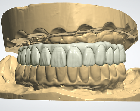 Full Arch Prosthesis