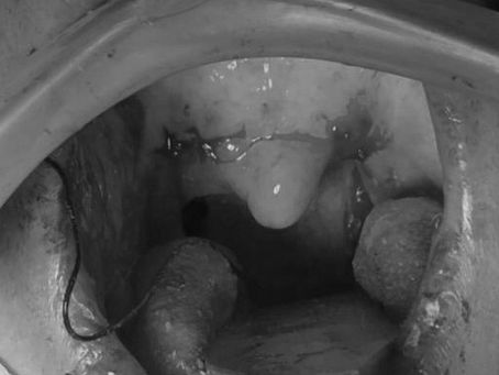 Dúvidas no pós-operatório: cirurgias da garganta 