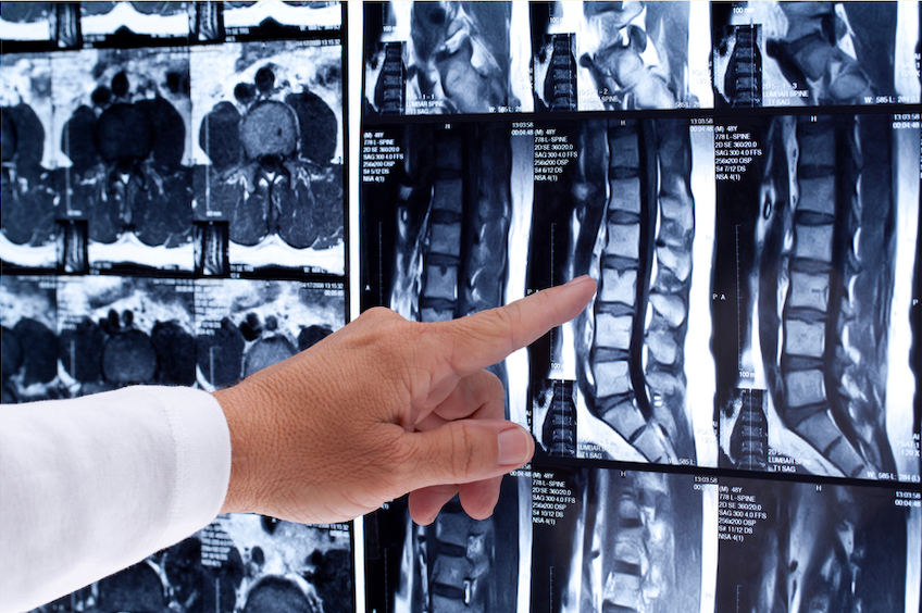 Hand in white coat points at spinal MRI scans on a lightbox, showing detailed black-and-white medical images and labels