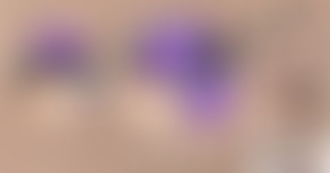 疣,係一種皮膚好困擾的病。 透過過濾性病毒而感染,會出現係身體不同部位...