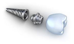 Implantes.jpg