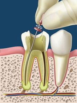 Endodoncias.jpg