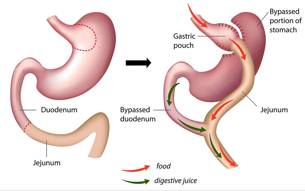 Tube Stomach in The Surgical Treatment of Obesity? Is Roux-En-Y Gastric Bypass?