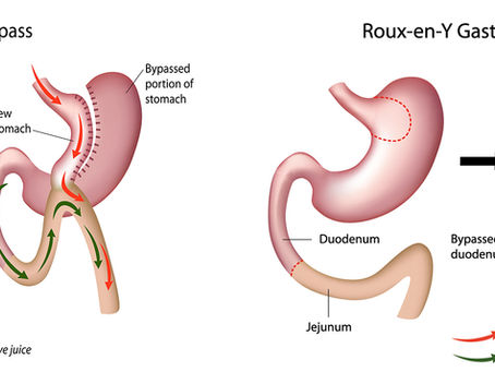 Mini Gastric Bypass? Is Roux-en-Y Gastric Bypass?