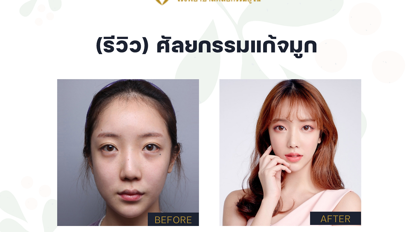 (รีวิว) ศัลยกรรมแก้จมูก โรงพยาบาลศัลยกรรมยูโน (YUNO Plastic Surgery) (ตอนที่ 1)