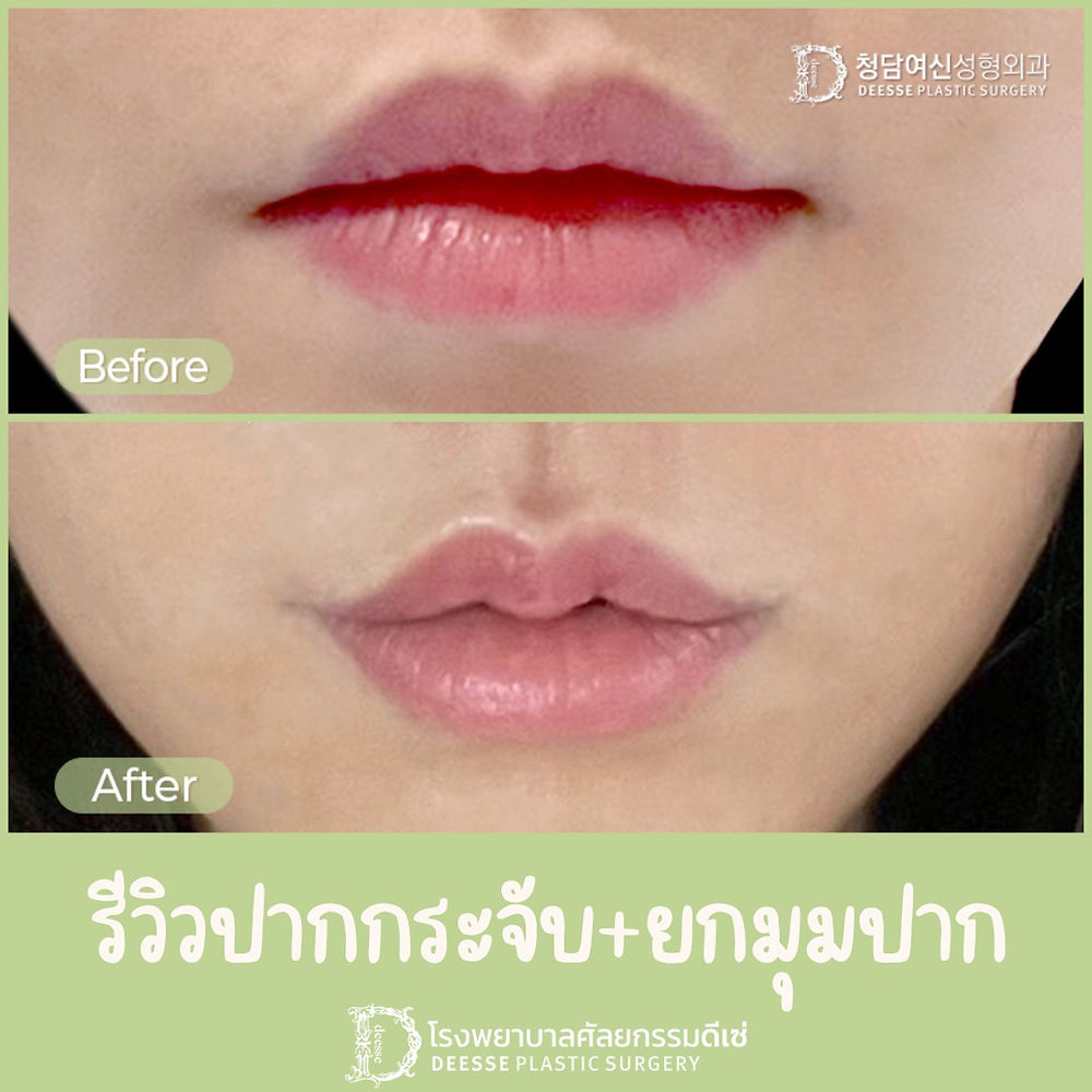 ศัลยกรรมมุมปาก