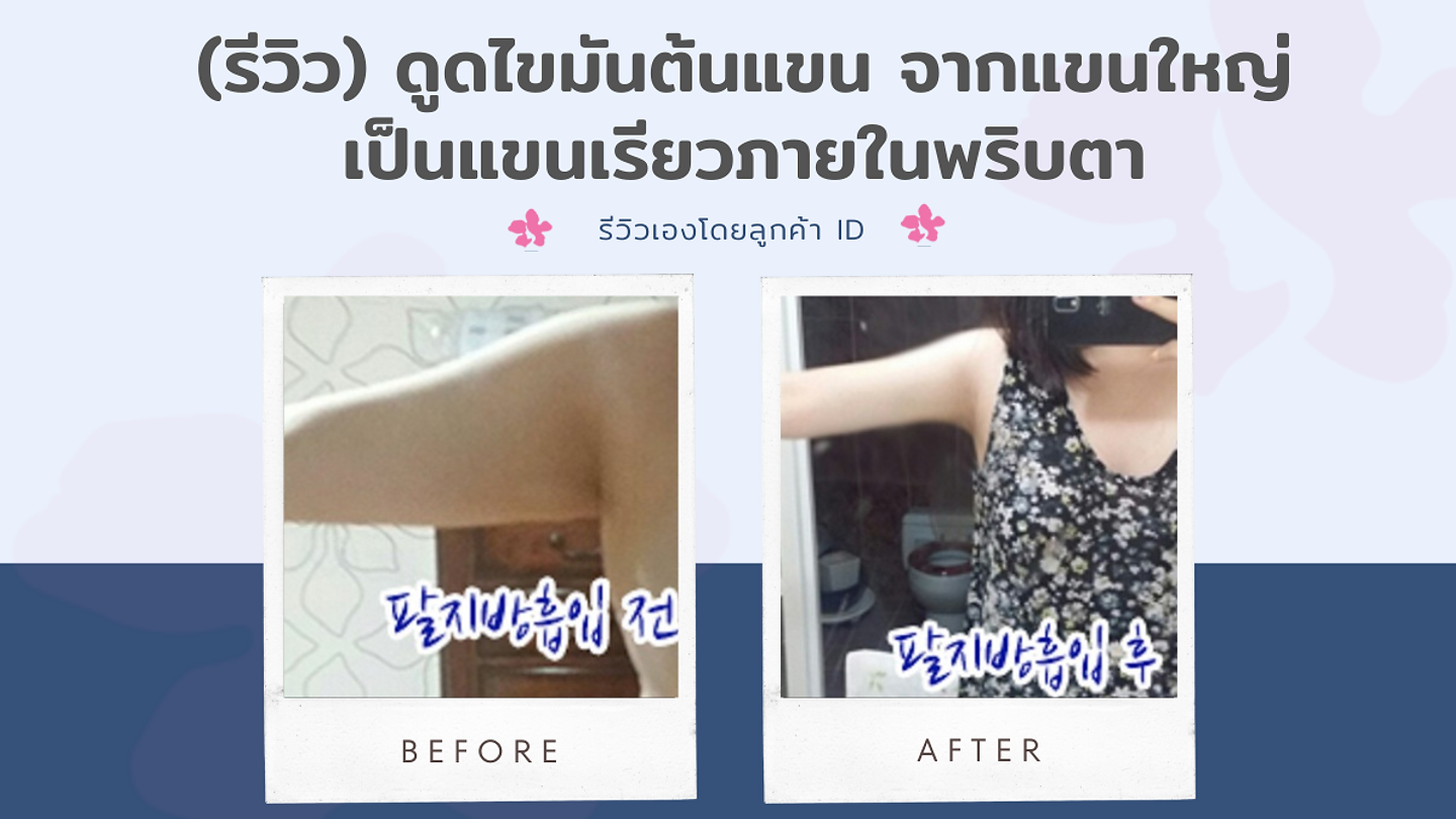 (รีวิว) ดูดไขมันต้นแขน จากแขนใหญ่เป็นแขนเรียวภายในพริบตา โรงพยาบาลศัลยกรรมไอดี (ID Hospital) (ตอนที่ 1)
