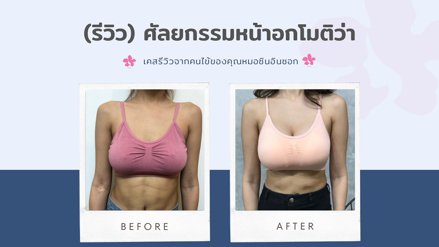 (รีวิว) ศัลยกรรมหน้าอกโมติว่า กับดร.ซินอินซอก โรงพยาบาลศัลยกรรมไอดี (ID Hospital) (ตอนที่ 2)
