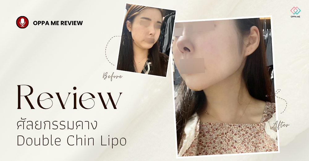 ศัลยกรรมคาง