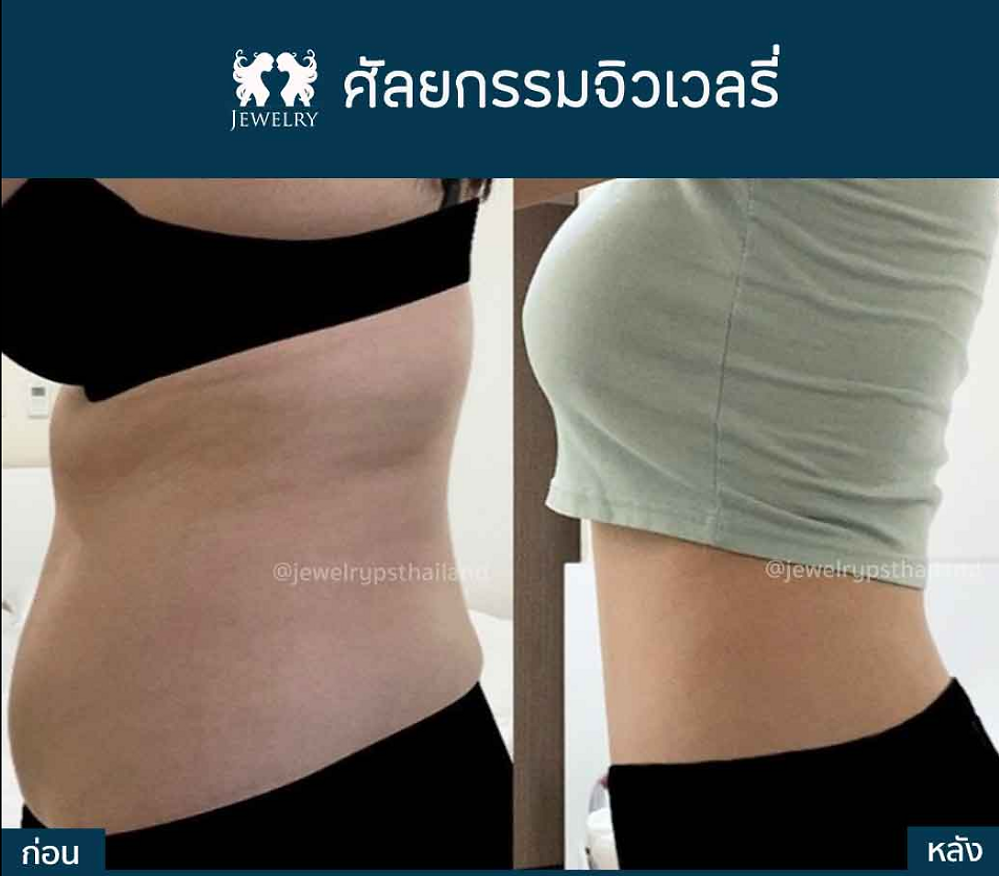 ศัลยกรรมดูดไขมันหน้าท้อง