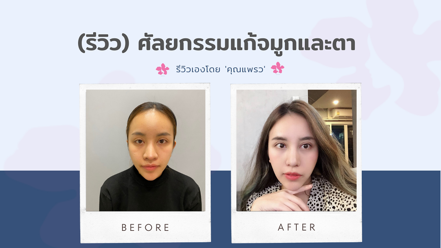 (รีวิว) ศัลยกรรมแก้จมูกและตา โรงพยาบาลศัลยกรรมไอดี (ID Hospital) (ตอนที่ 2)