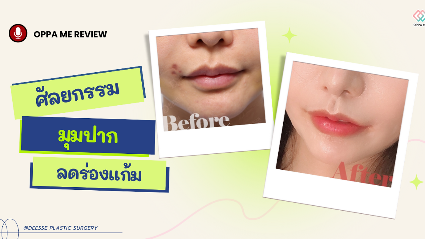 รีวิว: ศัลยกรรมมุมปาก ลดร่องแก้ม ที่โรงพยาบาลศัลยกรรมดีเซ่ @DEESSE PLASTIC SURGERY