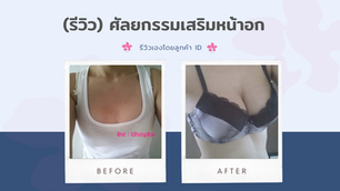 (รีวิว) ศัลยกรรมเสริมหน้าอก โรงพยาบาลศัลยกรรมไอดี (ID Hospital)