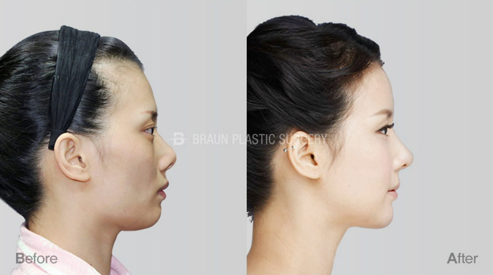 ศัลยกรรมตา จมูก โครงหน้า และปลูกถ่ายไขมัน