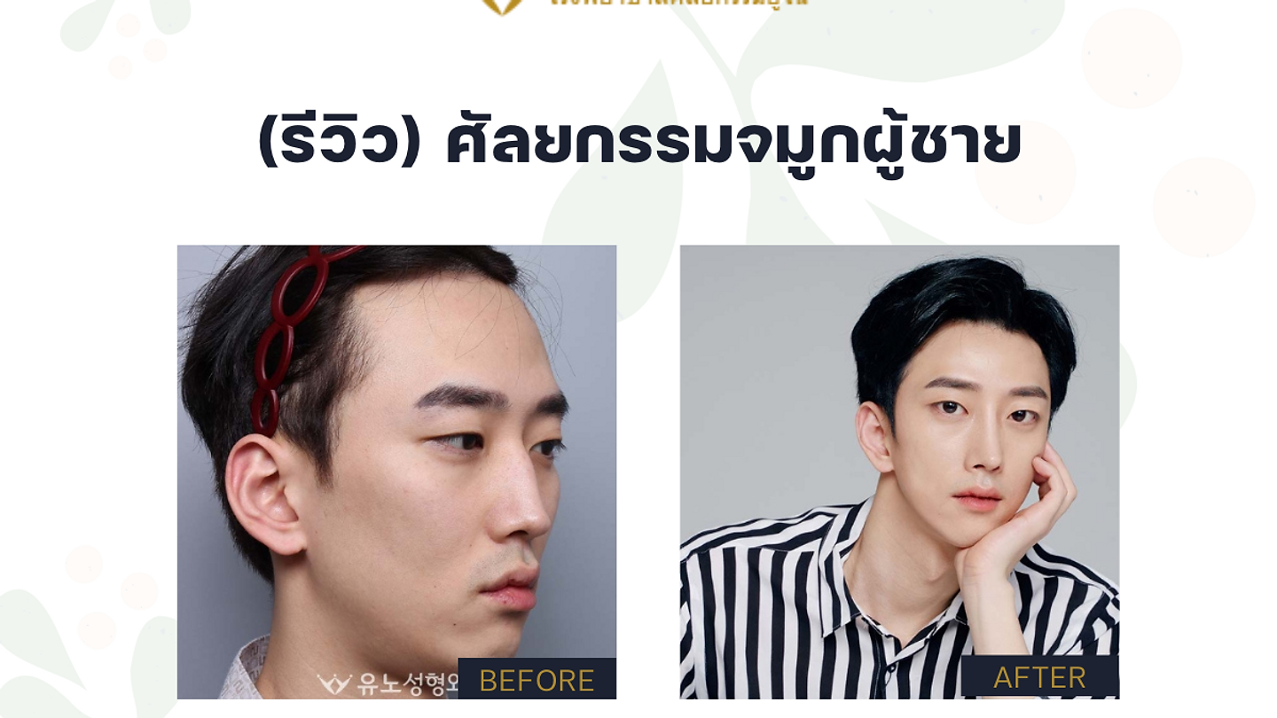 (รีวิว) ศัลยกรรมจมูกผู้ชาย โรงพยาบาลศัลยกรรมยูโน (YUNO Plastic Surgery) (ตอนที่ 5)