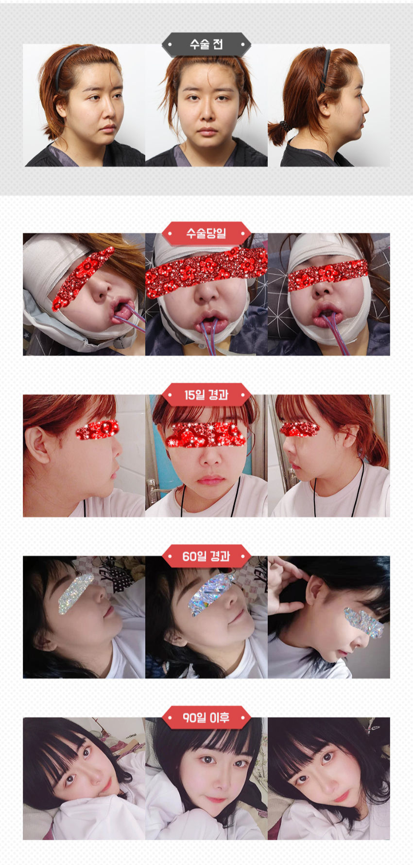 ศัลยกรรมคางแบบ DOUBLE CUT