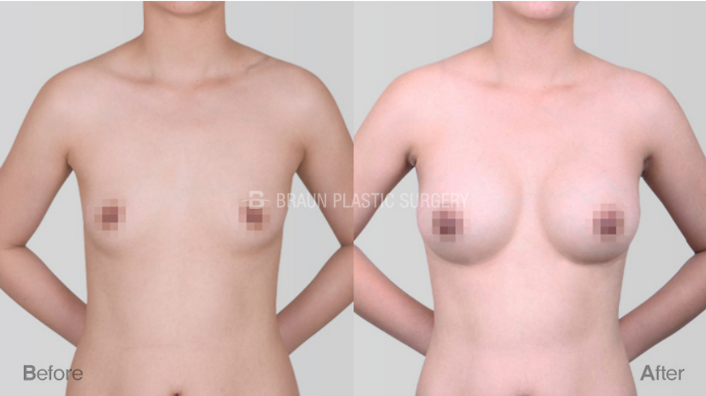 ศัลยกรรมหน้าอกและปลูกถ่ายไขมัน