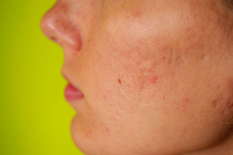 acne scar
