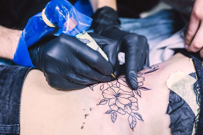tattoo removal